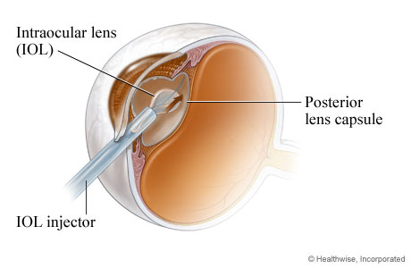 An intraocular lens being placed during cataract surgery.