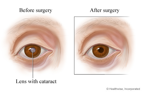 How the eye looks before and after cataract surgery.