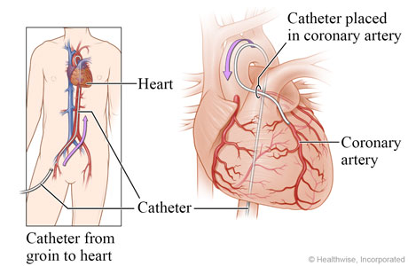Catheter going from groin to heart, with detail of catheter in a coronary artery.