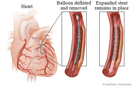 Deflated balloon leaving an expanded stent in place.