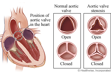 A normal aortic valve and aortic valve stenosis