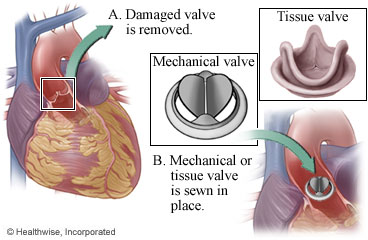Picture of mechanical and tissue valves and where they fit in the heart