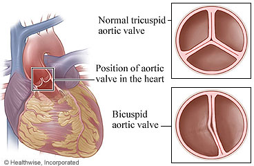 Picture of normal and bicuspid aortic valves