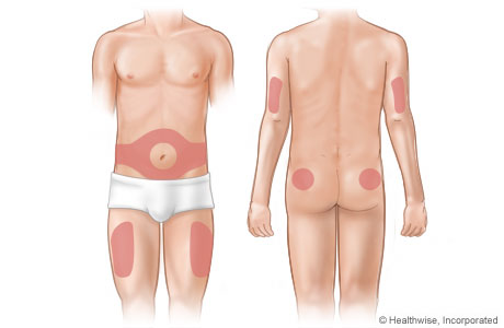 Areas of the body where insulin can be given