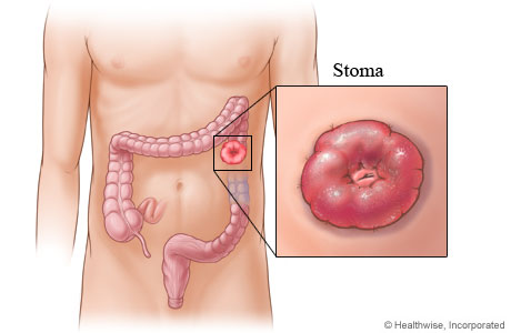A stoma created after colon surgery