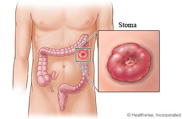 A colostomy stoma