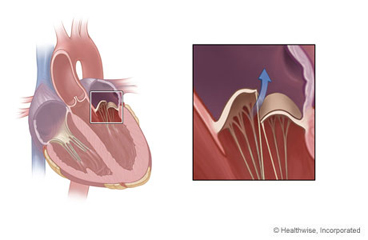 Location of mitral valve in the heart, with detail of mitral valve regurgitation