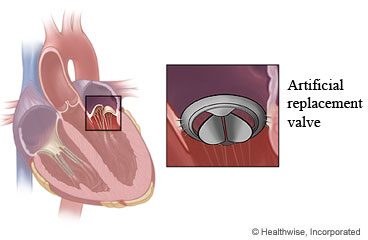 Artificial valve in the heart