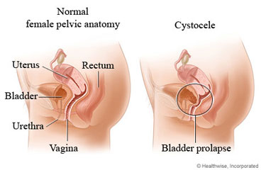 Normal female pelvic anatomy and of cystocele