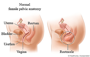 Normal female anatomy and rectocele