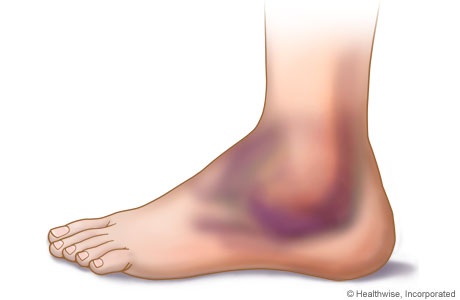 Picture of swelling and bruising of the ankle.
