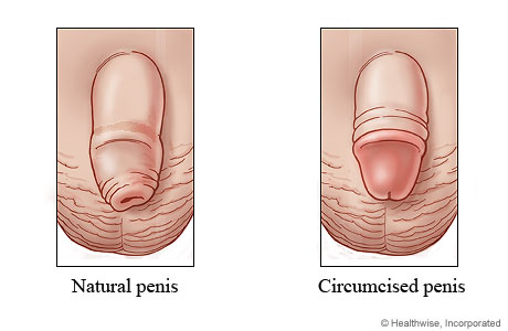 Natural penis and circumcised penis.