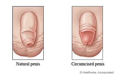 Natural and circumcised penises