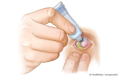 How to put eye ointment in the eye.