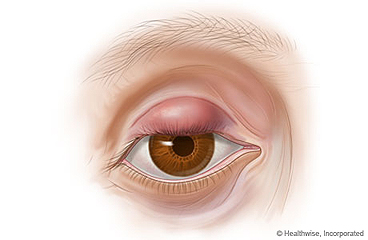 Picture of a stye