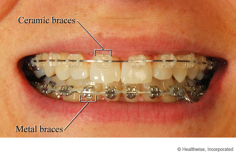 Mouth of someone with braces, showing ceramic braces on top and metal braces on the bottom.
