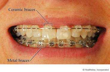 Ceramic braces and metal braces