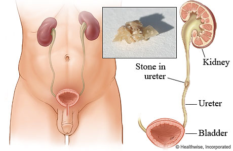 A kidney stone in the ureter.