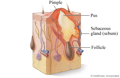 Infected gland and pimple.