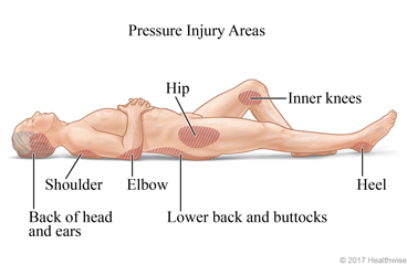 Areas of the body where pressure injuries often happen