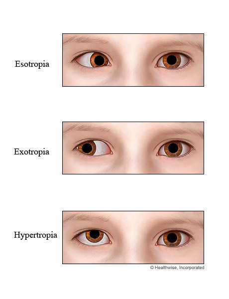 Types of strabismus.