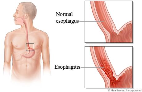 Normal esophagus compared to esophagitis.