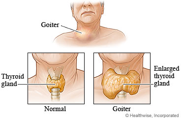 A normal thyroid gland and a goiter
