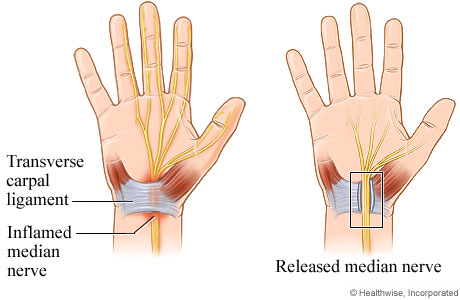 Open carpal tunnel release surgery.