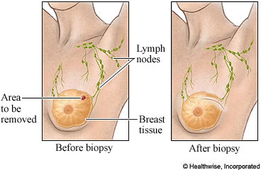 Before and after breast biopsy