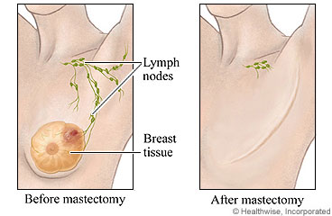 Picture of before and after a mastectomy