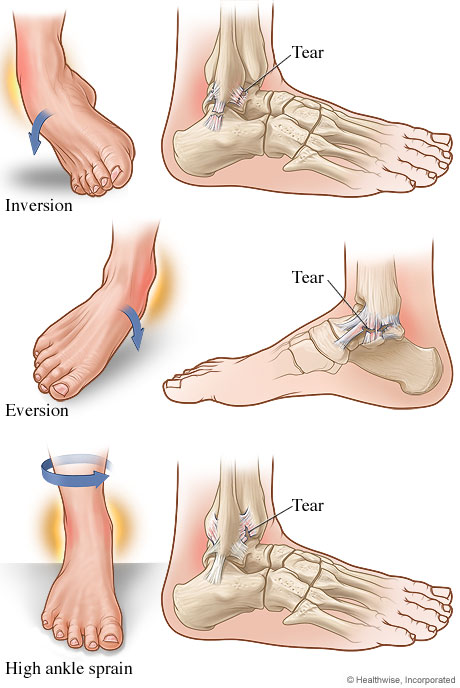 Types of ankle sprains.