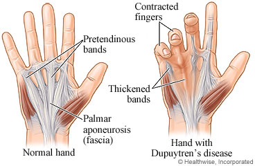 Normal hand structures and a hand with Dupuytren's contracture