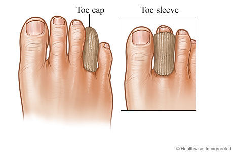 A toe cap on a toe and a toe sleeve on a toe.