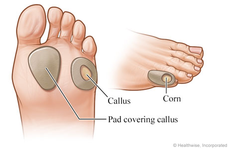 Pads on corn on little toe and on calluses on bottom of foot.