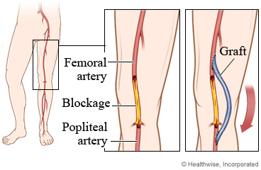 A femoropopliteal bypass surgery