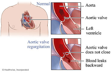 Normal aortic valve and aortic valve regurgitation