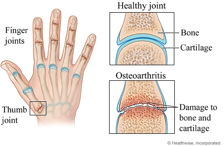 Osteoarthritis of the hand.