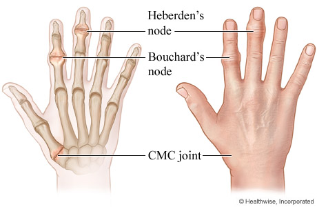 Skeletal and outside view of hand showing bony nodes at the joints.