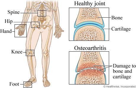 Joints commonly affected by osteoarthritis.