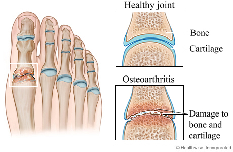 Healthy joint and osteoarthritis of the foot.