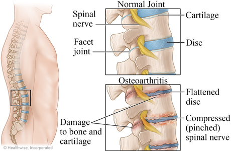 Normal spine and osteoarthritis of the spine.