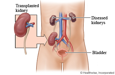 A healthy donor kidney transplanted into a person with diseased kidneys