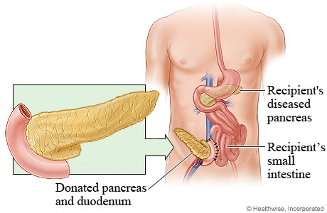 Pancreas transplant.