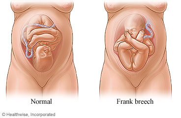 Normal and frank breech position of fetus