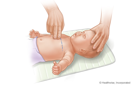 Where to position hands for doing CPR chest compressions on a baby