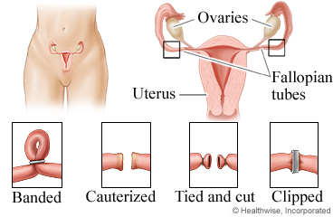 Ligation methods for female sterilization.