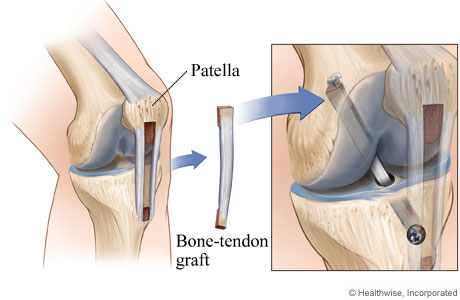 Picture of a bone and knee tissue graft for ACL surgery.