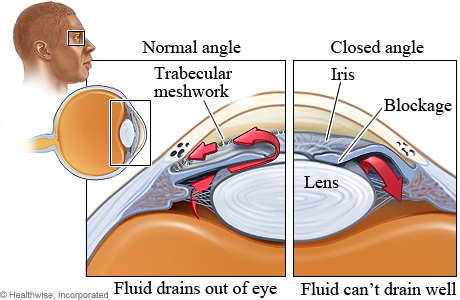 Picture of the structures affected by closed-angle glaucoma.