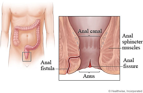 Picture of anal fissure and anal fistula.