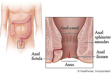 Picture of anal fistula